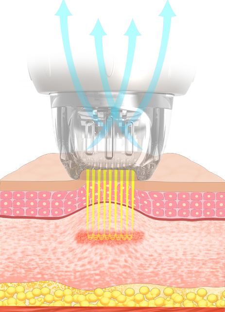 Microneedling Vaakum