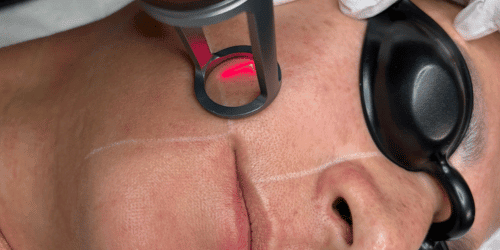 thulium laser
