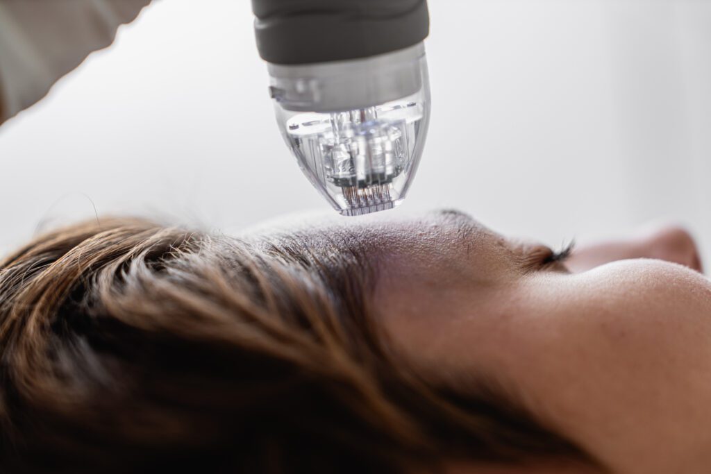 Microneedle RF lifting procedure. Hardware cosmetology.